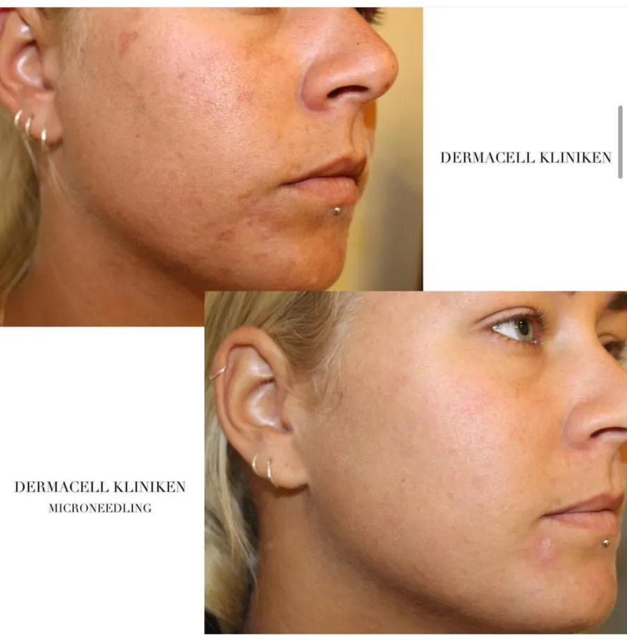 Fore och efter Microneedling 1