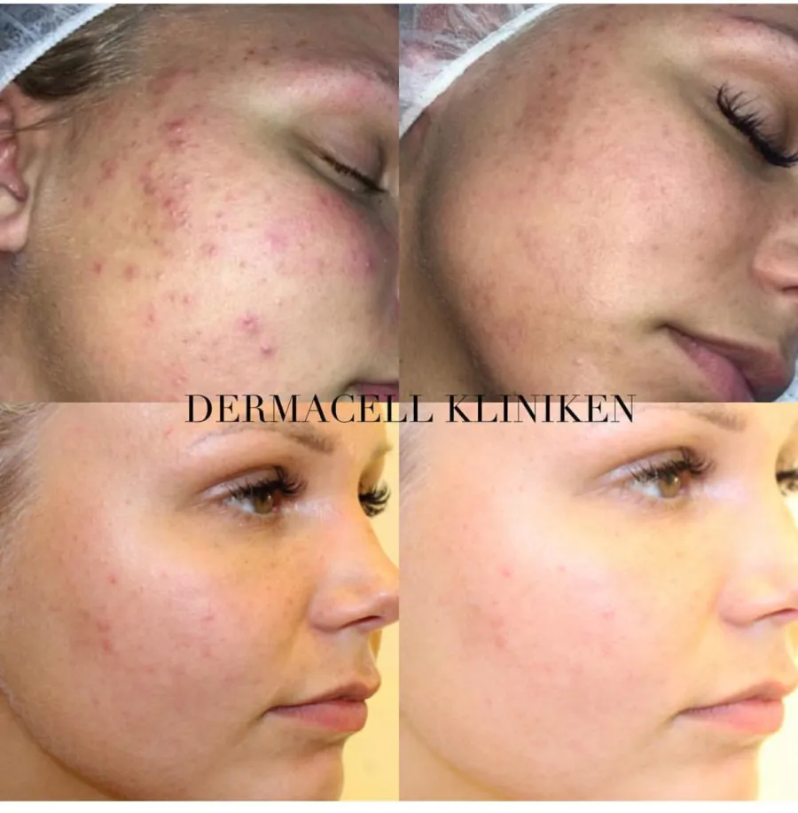 Fore och efter Microneedling 2