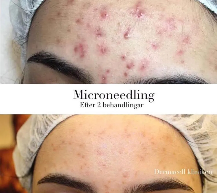 Fore och efter Microneedling 3
